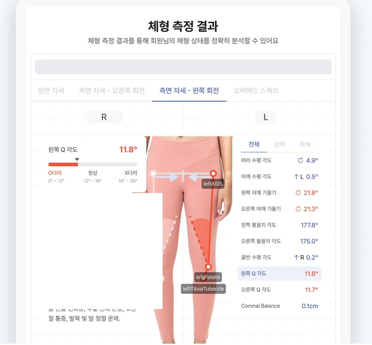 바디닷 체형 측정 결과 리포트 — 무릎 정렬(Q각도)