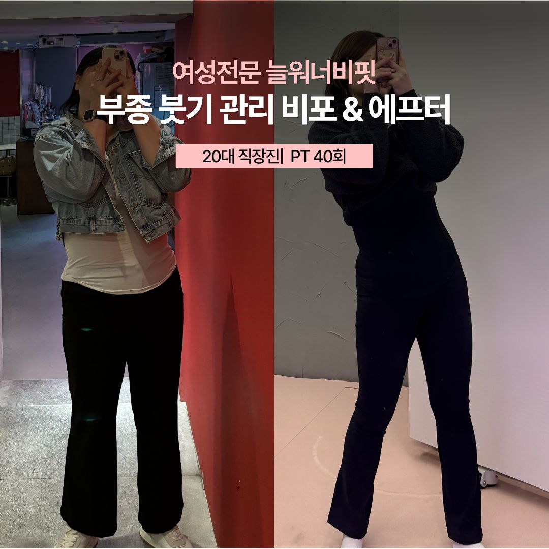 부종 붓기 관리 비포 애프터, 20대 직장인 · PT 40회