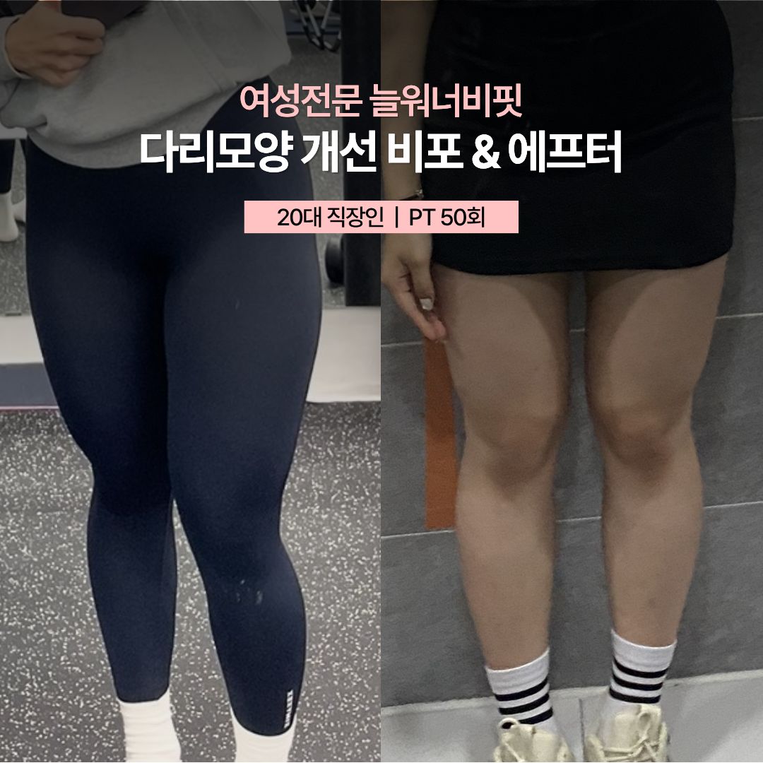 다리모양 개선 비포 애프터, 20대 직장인 · PT 50회