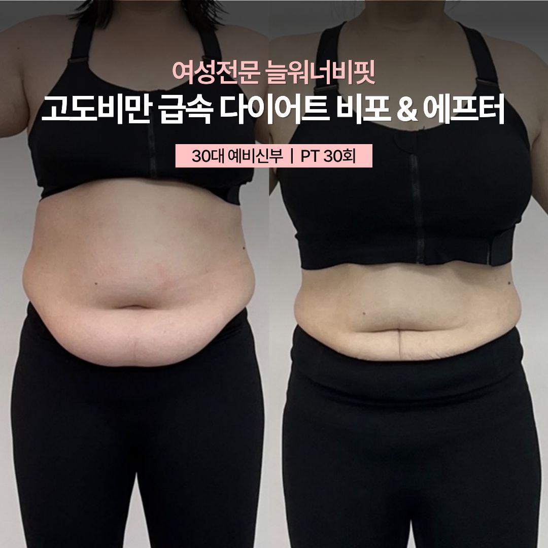 고도비만 급속 다이어트 비포 애프터, 30대 예비신부 · PT 30회